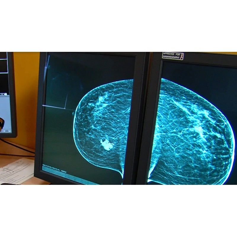 ČR - zdravotnictví - mamografie - vyšetření